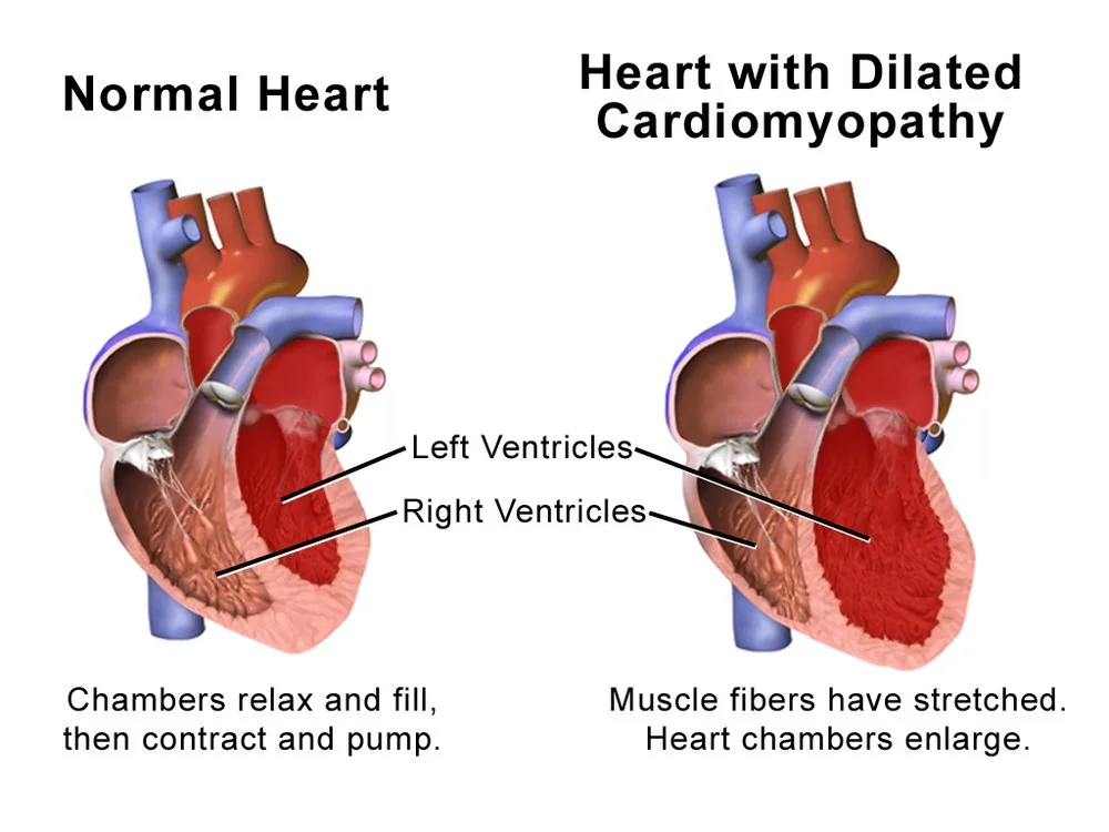 Cutaway illustration comparing a normal heart with one affected by dilated cardiomyopathy, showing an enlarged left ventricular cavity with a thinned wall.