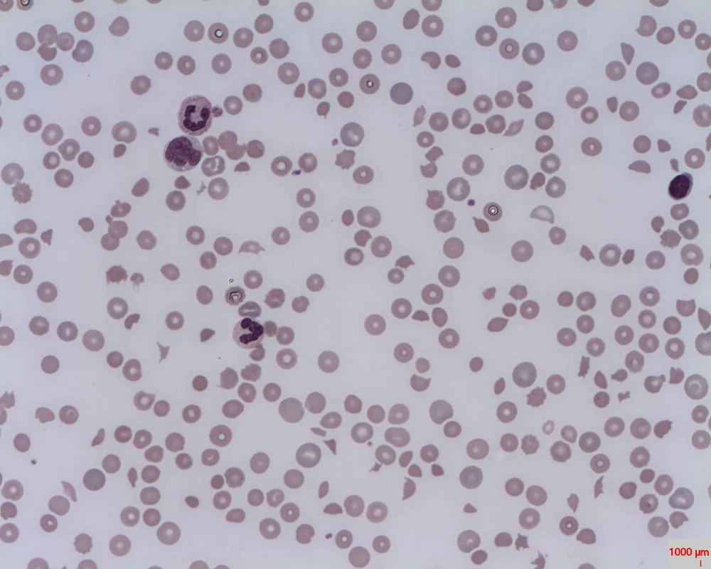 Peripheral blood film showing schistocytes, irregular fragmented red blood cells, alongside spherocytes, in microangiopathic haemolytic anaemia.