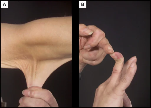 Two clinical photographs. Panel A shows skin on the forearm being stretched away from the arm to a marked degree. Panel B shows a finger bent backwards well beyond the normal range.