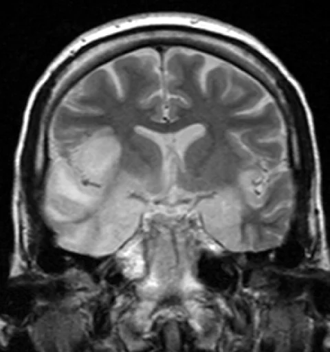 Coronal T2-weighted MRI brain scan showing high signal intensity in both temporal lobes, more marked on the right, involving the hippocampal formation and insula, with associated mass effect.