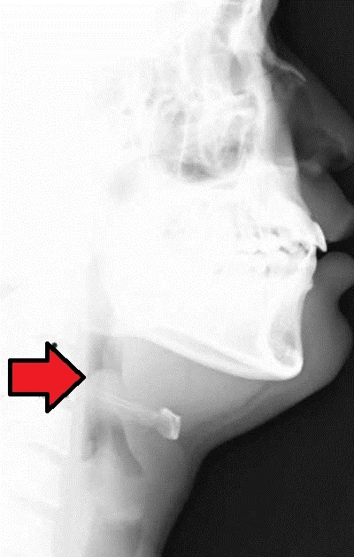Lateral soft tissue radiograph of the neck showing a markedly swollen, rounded epiglottis projecting into the airway above the larynx, resembling the shape of a thumb.