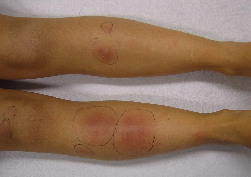 Photograph of the shins showing multiple tender, erythematous, ill-defined nodules typical of erythema nodosum, some with a bruise-like discolouration.