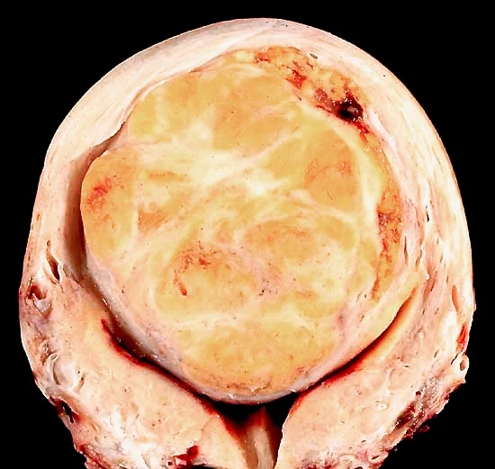 Hysterectomy specimen showing a large, solitary uterine leiomyoma in the fundus, distorting the endometrial cavity.