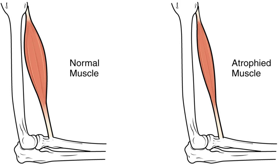 Side-by-side illustration of an upper limb showing a normal, full-bellied muscle on the left and a markedly thinned, atrophied muscle of the same group on the right.