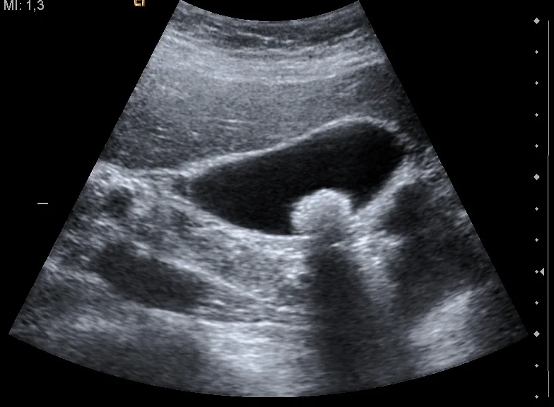 Transabdominal ultrasound of the gallbladder showing a bright echogenic focus within the gallbladder lumen with a dark acoustic shadow extending beneath it.