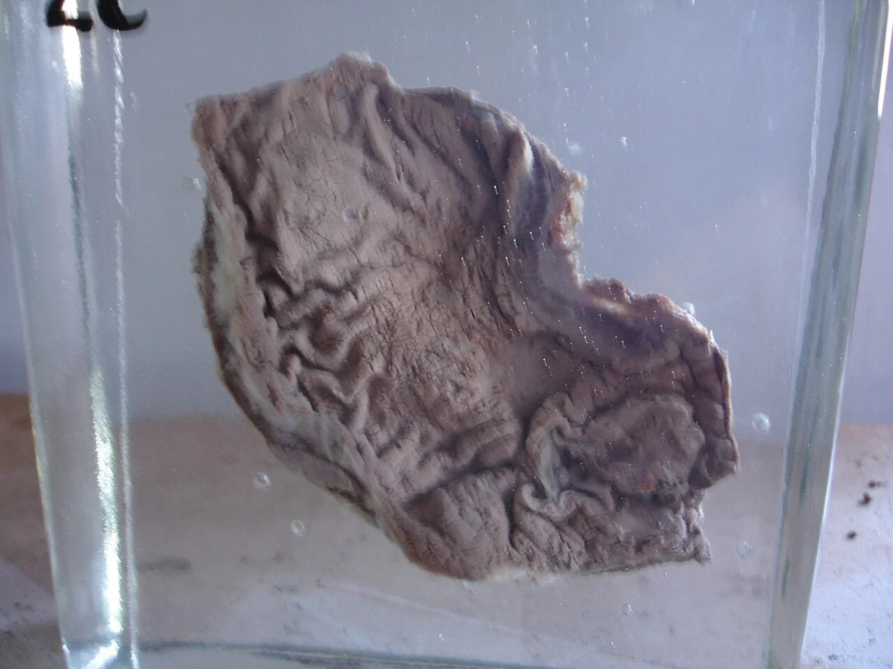 Resected stomach specimen showing an ulcerated carcinoma with raised, irregular, everted margins.
