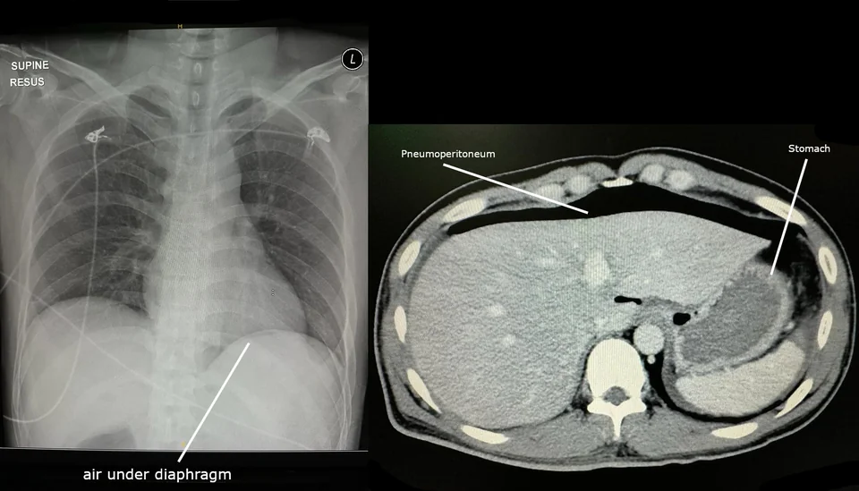 Erect chest radiograph showing a crescent of dark gas beneath the left hemidiaphragm, separating it from the underlying gastric shadow, indicating free intraperitoneal air.