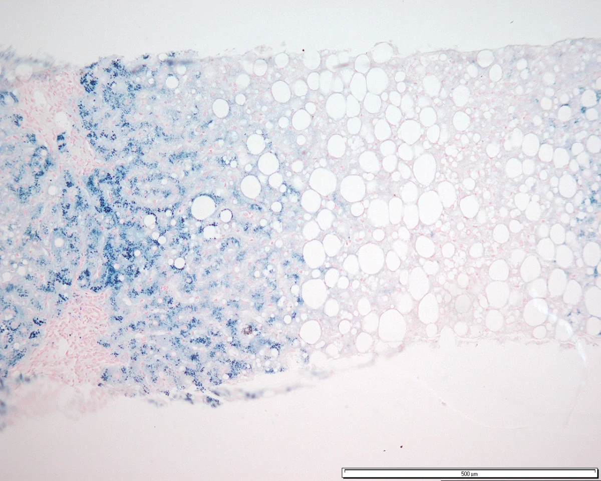 Liver histology stained with Perls Prussian blue, showing abundant blue-staining iron deposits within hepatocytes.