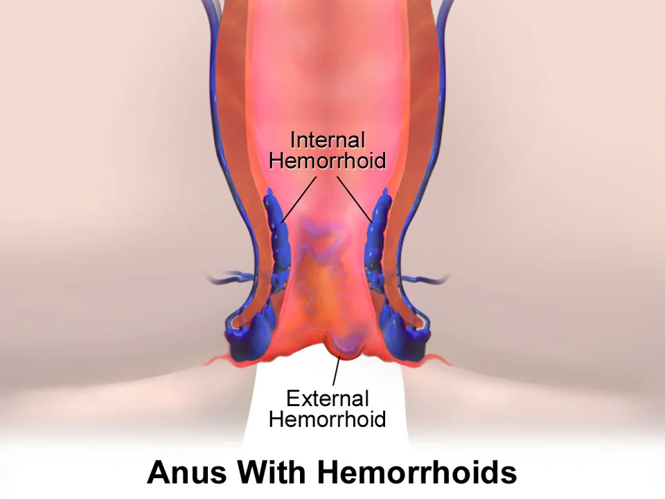 Cross-sectional illustration of the anal canal showing dilated blue vascular structures above the anal verge labelled internal haemorrhoid, and a further dilated vessel at the anal margin labelled external haemorrhoid.