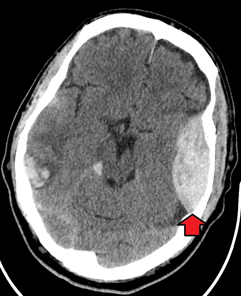 Axial CT head showing a large biconvex (lens-shaped) hyperdense collection over the right cerebral hemisphere, causing significant midline shift, with an associated skull fracture.