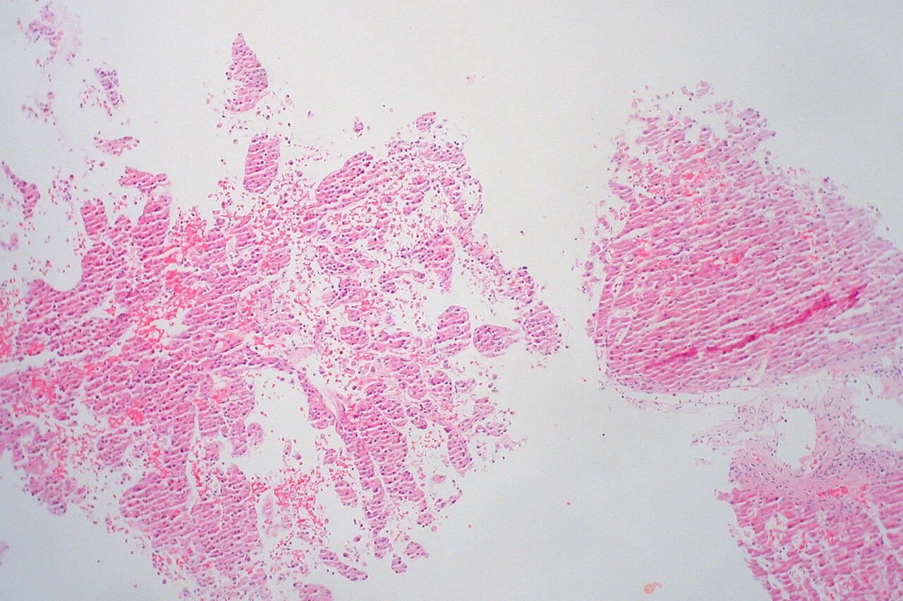 Resected liver specimen showing a large pale tumour nodule of hepatocellular carcinoma within a cirrhotic liver with a nodular background.