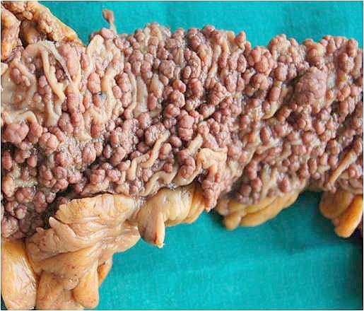 An opened colectomy specimen showing the mucosal surface densely carpeted with hundreds of small rounded polyps along its entire length.