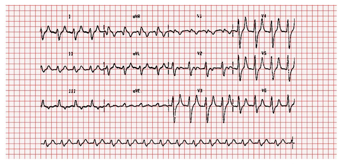 Twelve-lead electrocardiogram from a patient with severe hyperkalaemia showing broad QRS complexes, absent P waves and tall peaked T waves across the precordial leads.