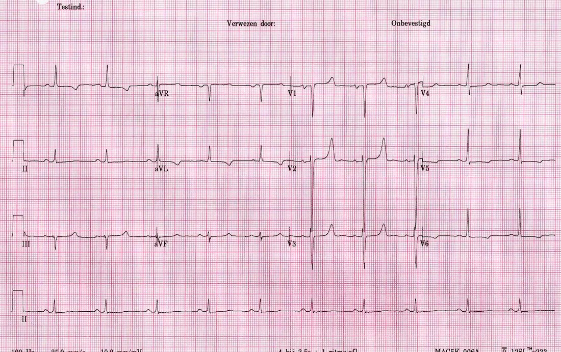 Twelve-lead electrocardiogram from a patient with hypocalcaemia showing a markedly prolonged QT interval due to lengthening of the ST segment, with normal-appearing T waves.