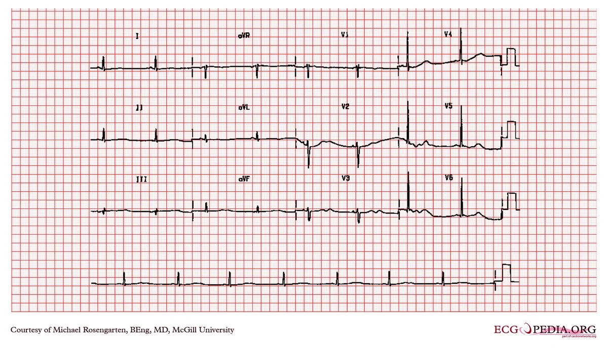 Twelve-lead electrocardiogram from a patient with hypokalaemia showing flattened T waves followed by prominent U waves, with ST segment depression across the precordial leads.