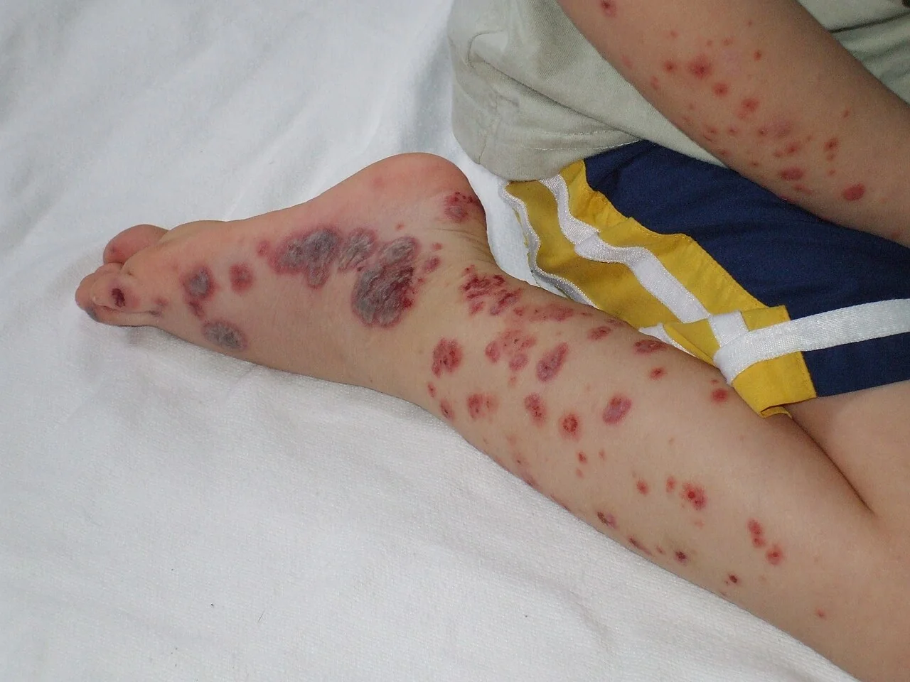 Photograph of a child's lower leg showing numerous discrete and confluent reddish-purple non-blanching purpuric spots concentrated over the shin and ankle.