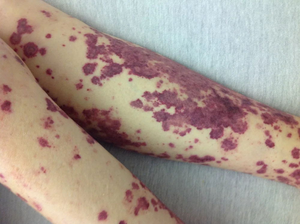 Photograph of skin showing a widespread petechial rash of small, non-blanching red-purple spots.
