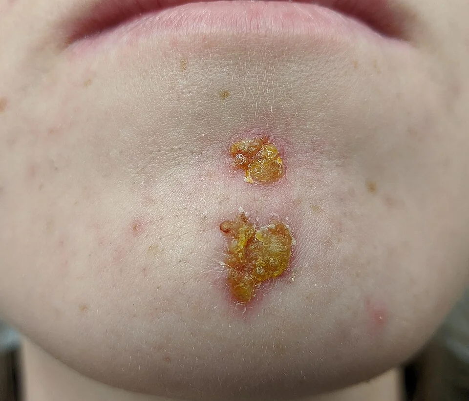 Photograph of a child's chin showing two areas of non-bullous impetigo with thick, golden, honey-coloured crusts on an erythematous base.