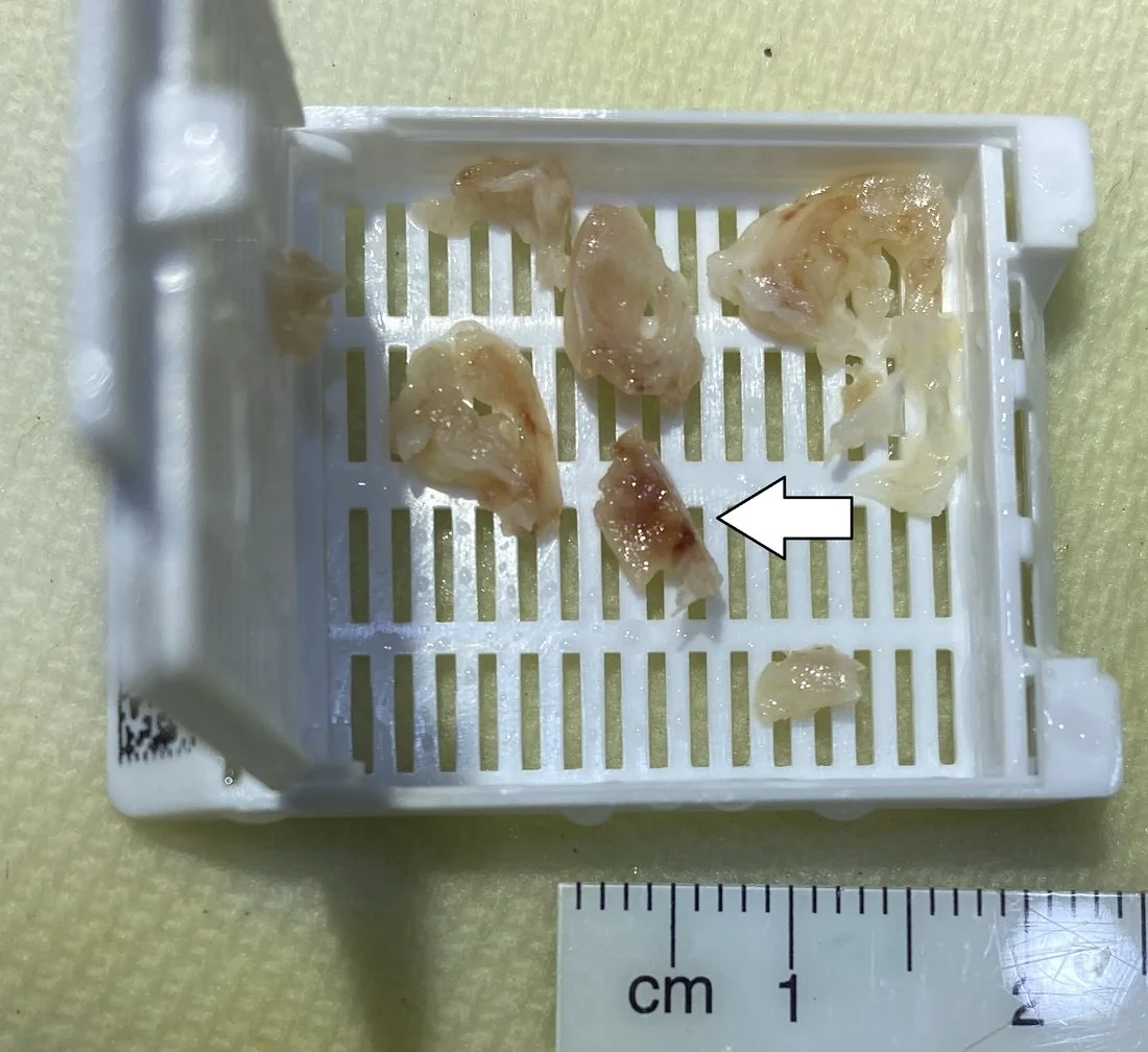 Post-mortem specimen of a heart valve showing a small granular red-brown vegetation adherent to the leaflet edge, the characteristic lesion of infective endocarditis.