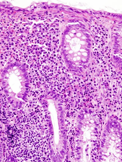 Endoscopic image of the colon in active ulcerative colitis showing diffusely erythematous, granular and friable mucosa with loss of the normal vascular pattern.
