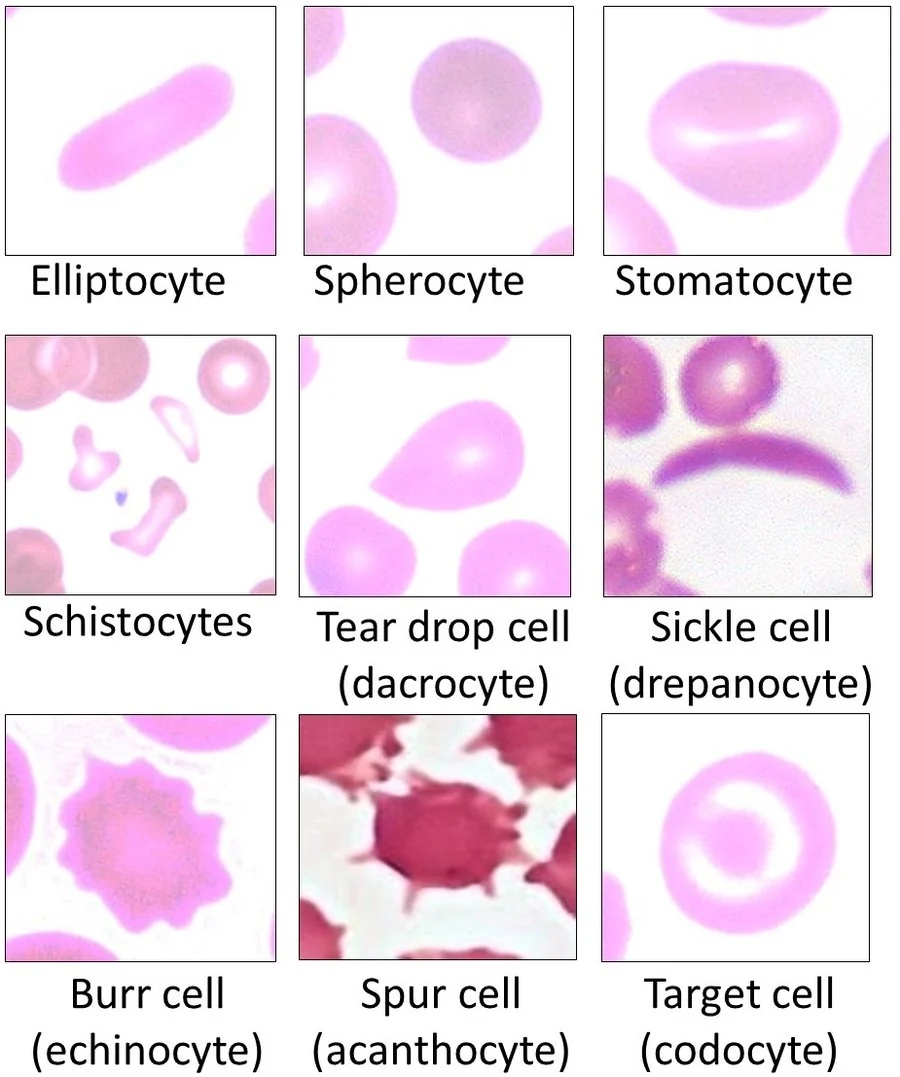 Composite micrograph showing abnormal red blood cell shapes including elliptocyte, spherocyte, stomatocyte, schistocyte, teardrop cell, sickle cell and echinocyte.