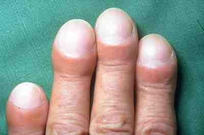 Close-up photograph of three fingers showing bulbous fingertips with increased curvature of the nails and loss of the normal angle between the nail and the nail fold.