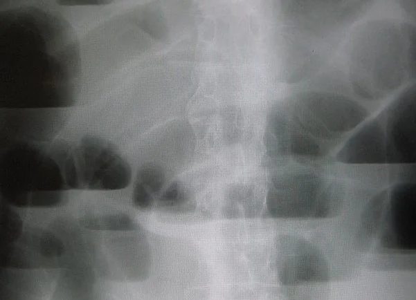 Supine abdominal radiograph showing multiple dilated loops of small bowel arranged centrally, with valvulae conniventes crossing the full width of the bowel and no gas visible in the colon or rectum.
