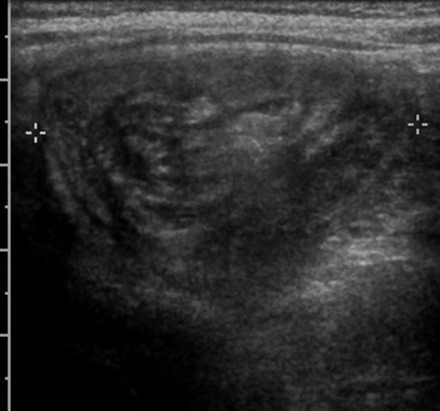 Transverse abdominal ultrasound image showing concentric alternating hypoechoic and hyperechoic rings, forming a target-like appearance within the bowel.