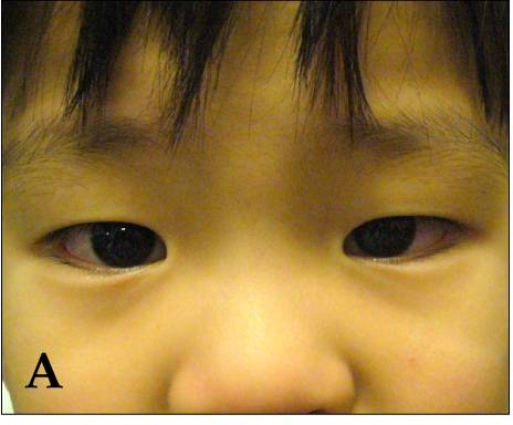 Close-up of a child's eye showing marked redness of the white of the eye, with a clear unaffected ring immediately around the coloured iris and no discharge.