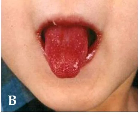 A child's mouth showing bright red, swollen lips with deep vertical cracks and bleeding, and a red tongue with prominent papillae.