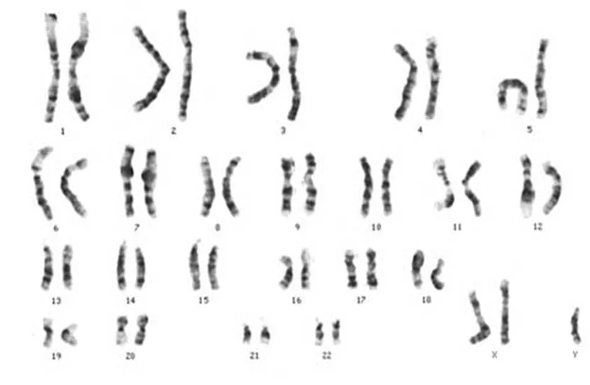 A karyotype showing 47 chromosomes with two X chromosomes and one Y chromosome.