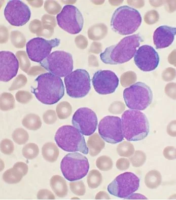 Bone marrow aspirate smear showing numerous lymphoblasts with scant cytoplasm and fine chromatin, characteristic of acute lymphoblastic leukaemia.