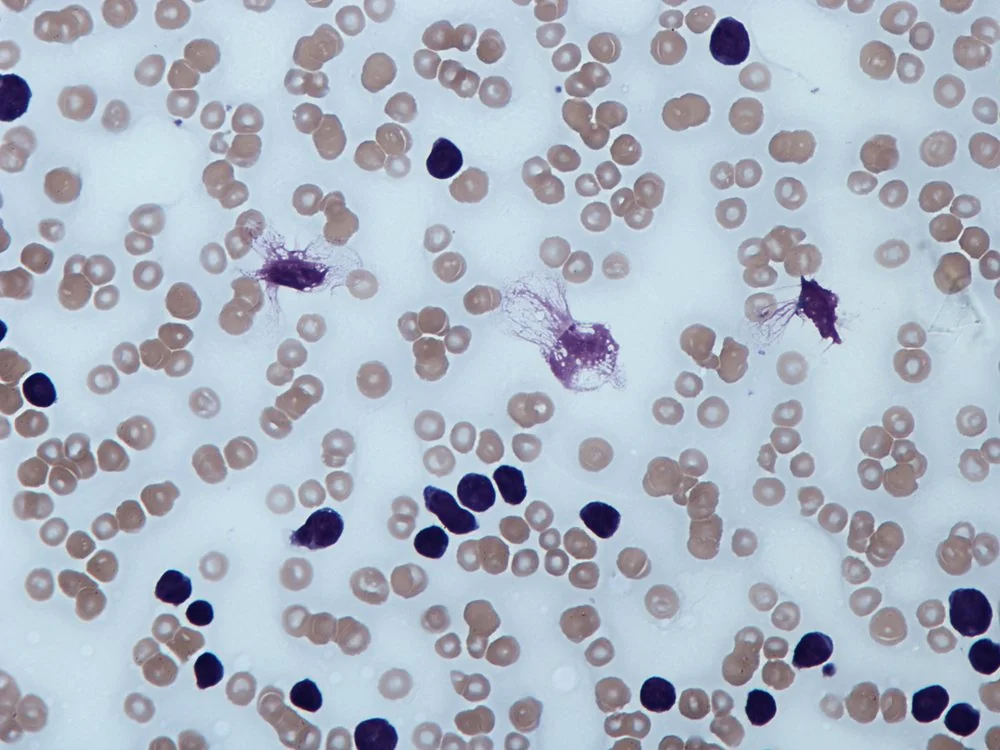 Peripheral blood film showing numerous small mature lymphocytes and smudge (smear) cells, characteristic of chronic lymphocytic leukaemia.