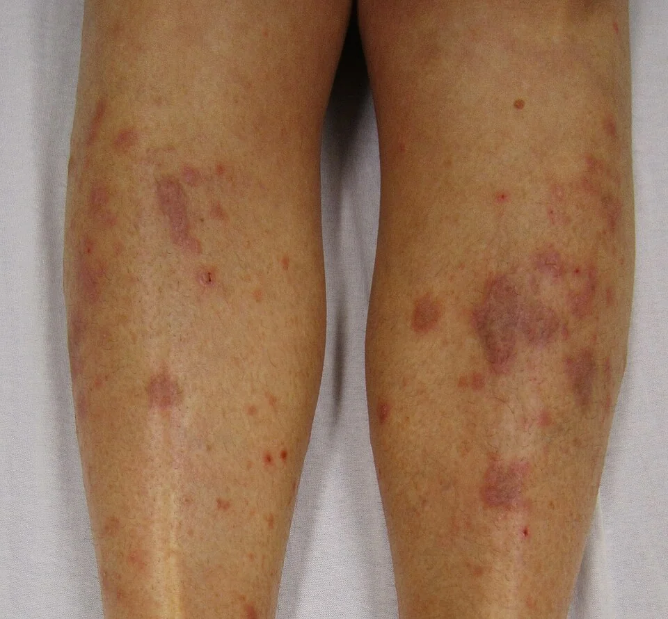 Photograph of the shins showing multiple violaceous, flat-topped, polygonal papules and plaques typical of lichen planus.