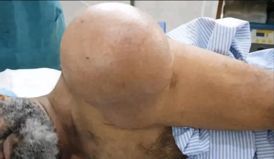 Photograph of a very large, smooth, dome-shaped subcutaneous swelling on the shoulder, with normal overlying skin, representing an unusually large lipoma.