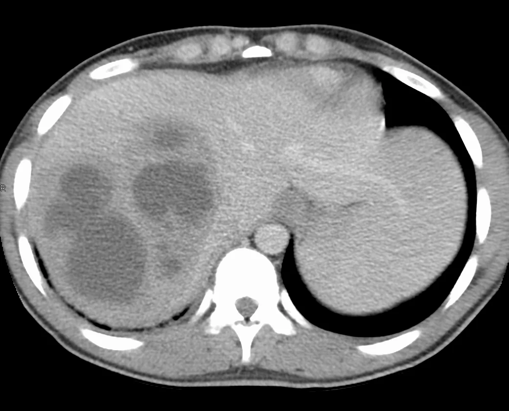 Contrast-enhanced CT of the abdomen showing a large rim-enhancing fluid collection within the right lobe of the liver.