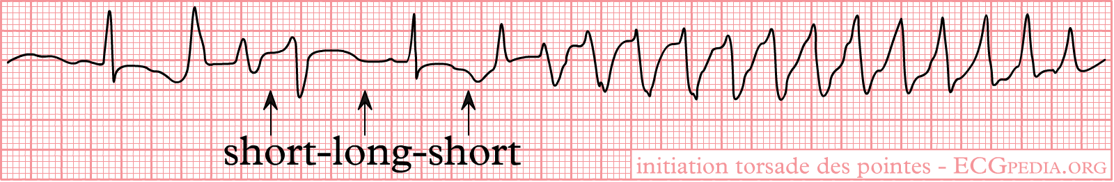 An ECG rhythm strip in which arrows label a short-long-short sequence of beats, immediately followed by the onset of a rapid polymorphic ventricular tachycardia whose complexes vary in amplitude and direction.