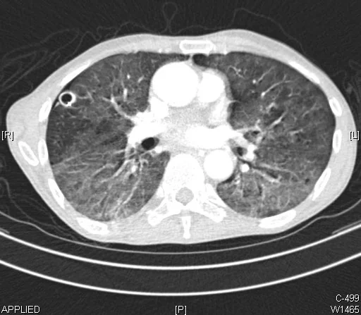 Axial CT of the chest on lung windows showing a small rounded thick-walled cavity in the anterior right lung, with widespread hazy ground-glass opacification throughout both lungs.