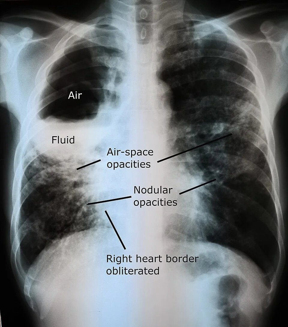 Labelled frontal chest radiograph showing a large cavity in the right upper to mid zone with a horizontal interface between air above and fluid below, together with widespread air-space and nodular opacities in both lungs and loss of the right heart border.