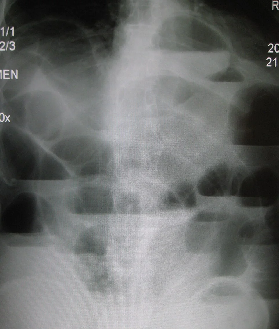 Erect abdominal radiograph showing several dilated loops of small bowel in the centre of the abdomen, each containing a horizontal air-fluid level, with no gas in the distal colon or rectum.
