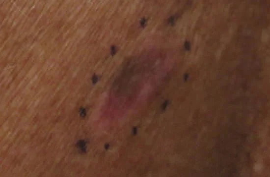 Photograph of a pigmented skin lesion on the back marked with surgical marker dots for biopsy, showing asymmetry, an irregular border and variation in colour from tan to dark brown.