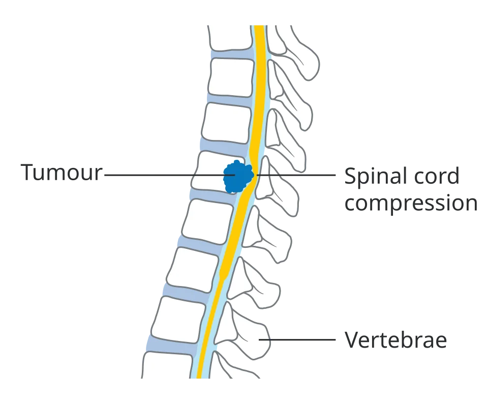 Diagram of a section of vertebral column in profile showing the spinal cord running through the vertebral canal, with a tumour arising in a vertebral body and extending backwards to indent and compress the cord.