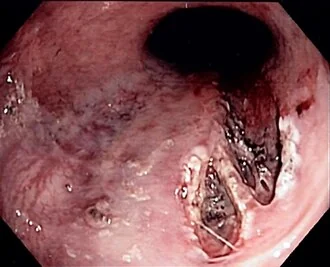 Endoscopic image showing a linear mucosal tear at the gastro-oesophageal junction characteristic of a Mallory-Weiss tear.