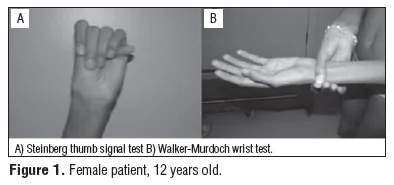 Two clinical photographs: the Steinberg thumb sign showing the thumb protruding beyond the ulnar border of a clenched fist, and the Walker-Murdoch wrist sign showing the thumb and little finger overlapping when wrapped around the opposite wrist.