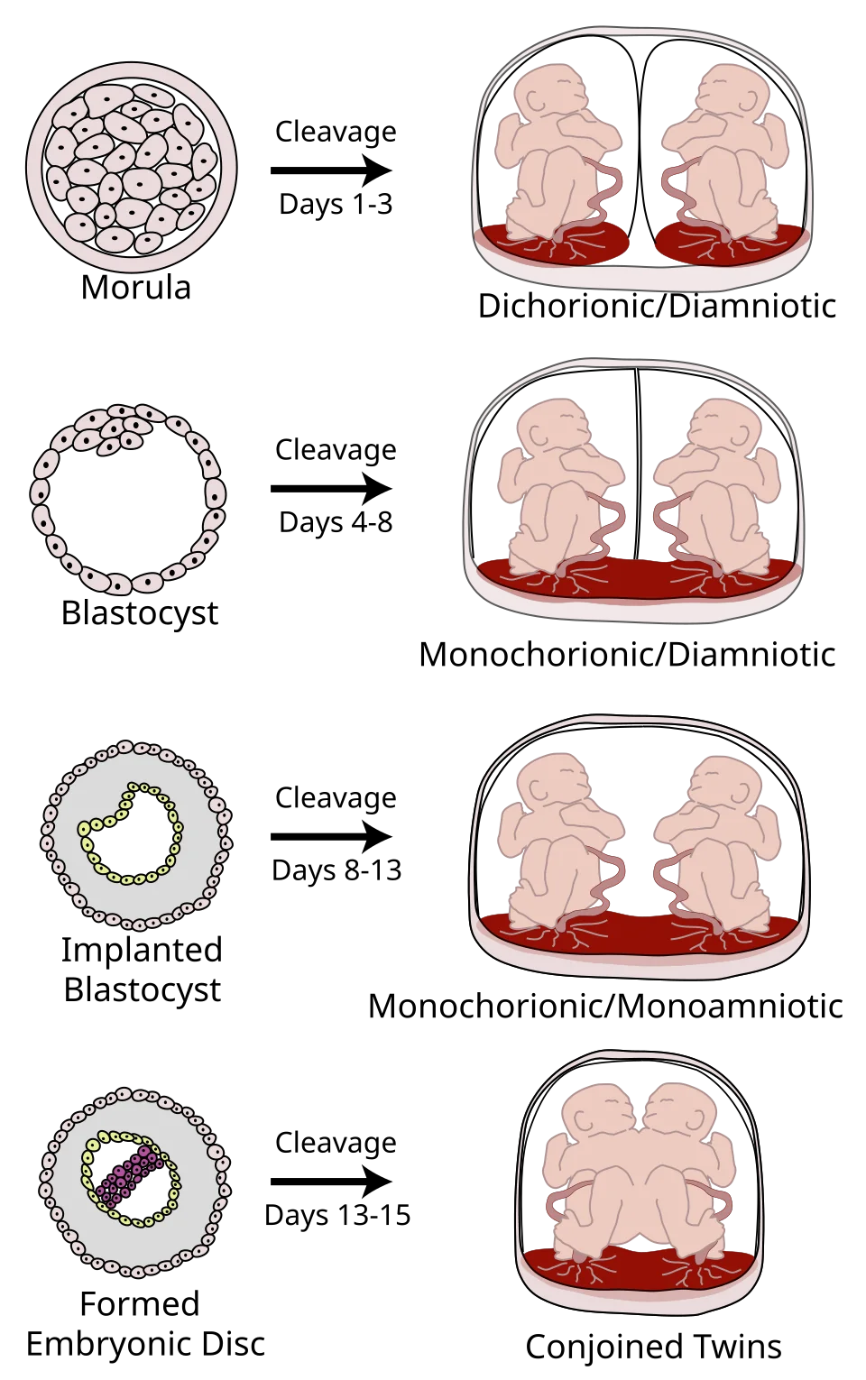 Diagram showing how the timing of cleavage in monozygotic twinning determines dichorionic diamniotic, monochorionic diamniotic, monochorionic monoamniotic or conjoined twins.