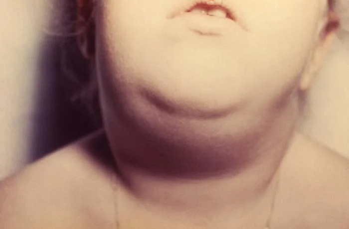 Photograph of the anterior neck and jawline of a child with bilateral swelling of the salivary glands due to mumps infection.