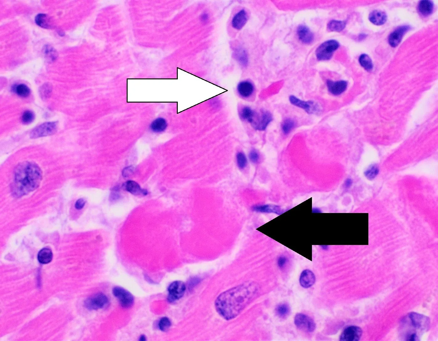 High-power haematoxylin and eosin stained section of myocardium showing pink muscle fibres infiltrated by small dark-staining inflammatory cells. A white arrow indicates a lymphocyte and a black arrow indicates a damaged muscle fibre with intensely pink cytoplasm and loss of its normal striations.