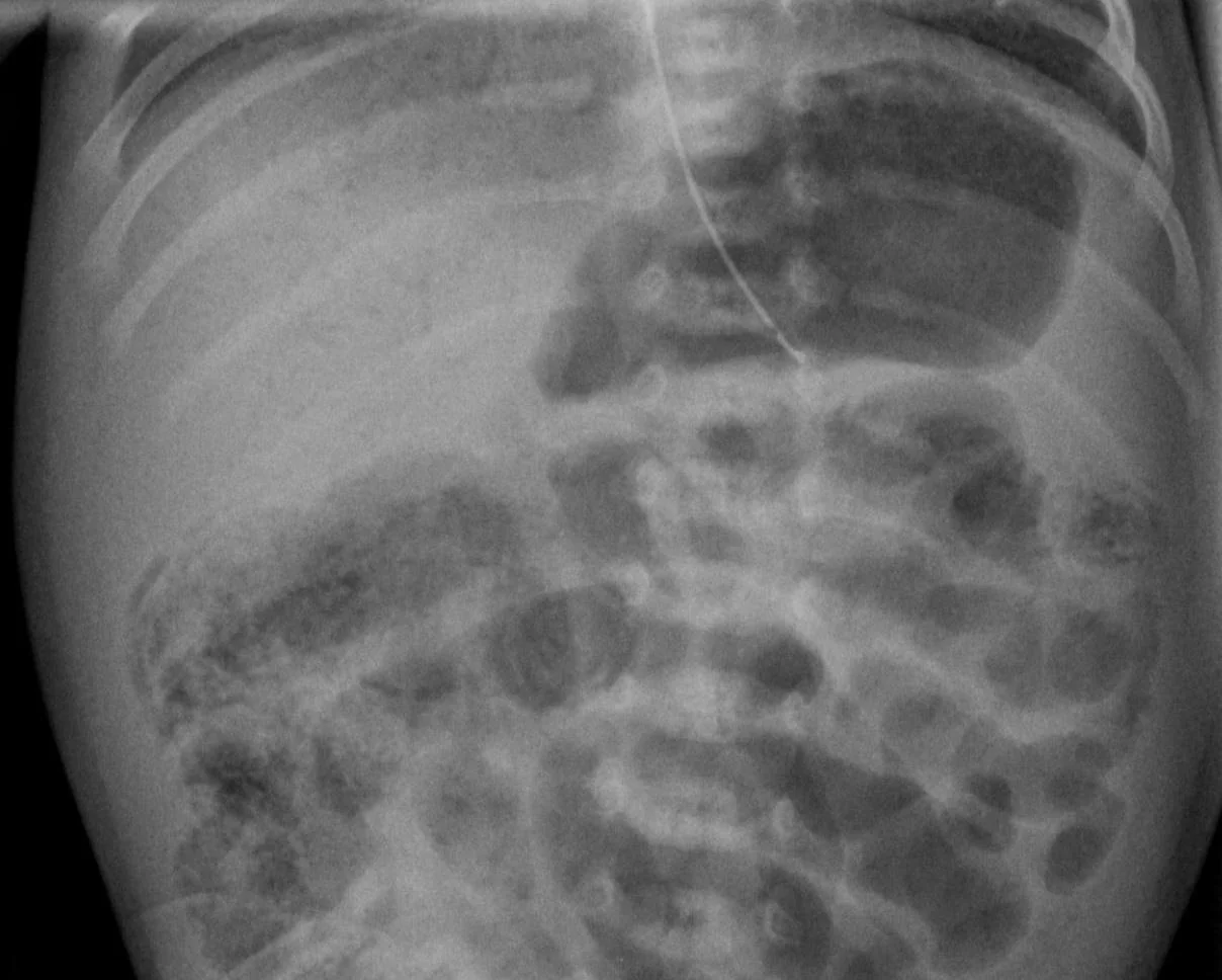Abdominal radiograph of a newborn showing dilated bowel loops with fine curvilinear and bubbly lucencies within the bowel wall, and branching lucencies over the liver.