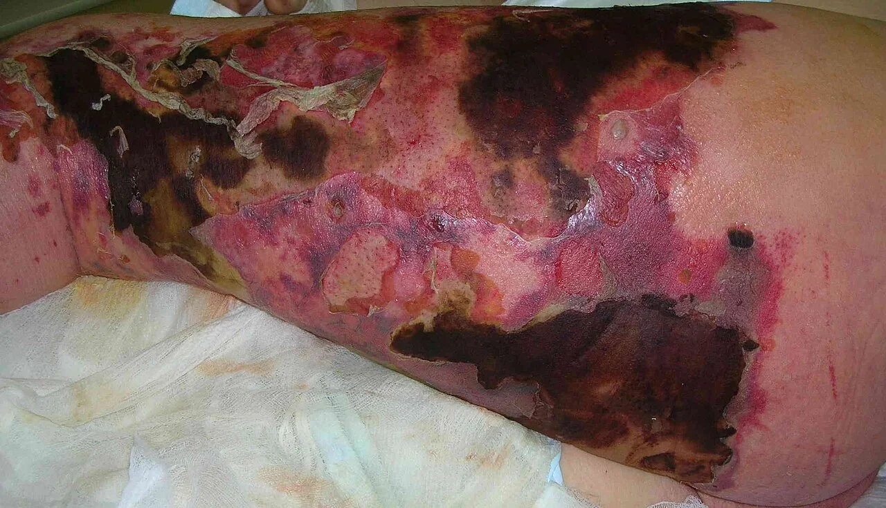 Preoperative photograph of the left leg of a patient with necrotising fasciitis, showing extensive erythema and areas of skin necrosis.