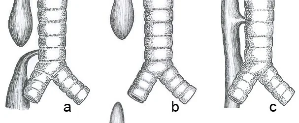 Line drawings of three configurations of the trachea and oesophagus: a blind upper oesophageal pouch with the lower oesophagus joining the trachea; a blind upper pouch with no connection at all; and an intact oesophagus with a fistulous track running to the trachea.